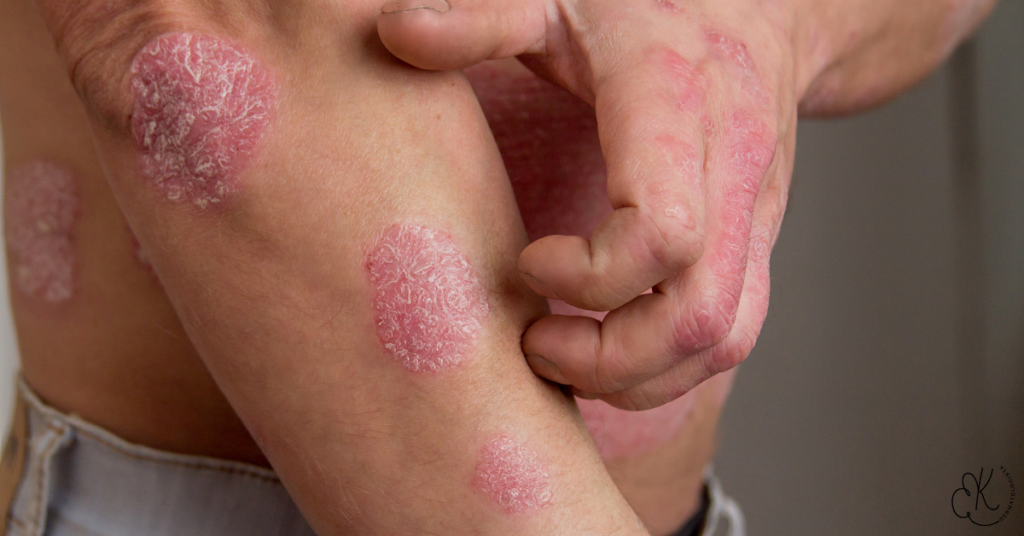 Close-up de lesões de psoríase na pele de um homem, mostrando placas vermelhas e descamativas.