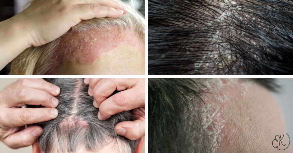 Imagens mostrando diferentes graus de psoríase no couro cabeludo, com descamação e inflamação.
