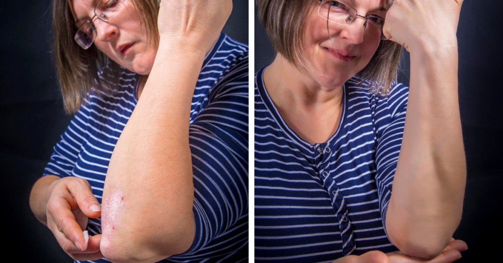 Comparação de uma mulher antes e depois do tratamento da psoríase