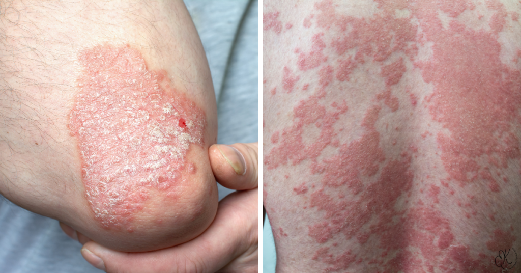 Comparação entre psoríase em cotovelo e psoríase nas costas