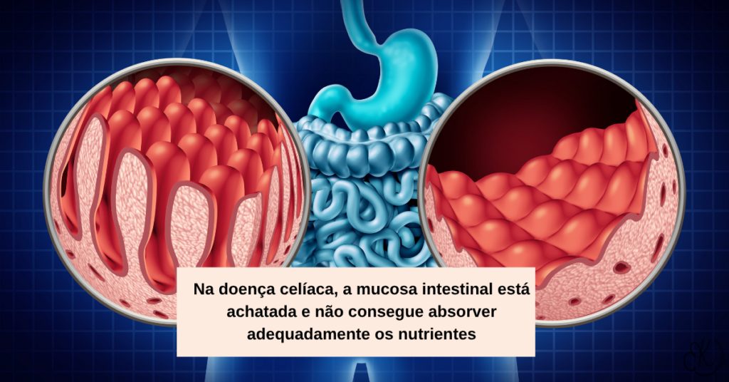 Ilustração comparando vilosidades intestinais normais e achatadas na doença celíaca, com estômago e intestino ao centro.