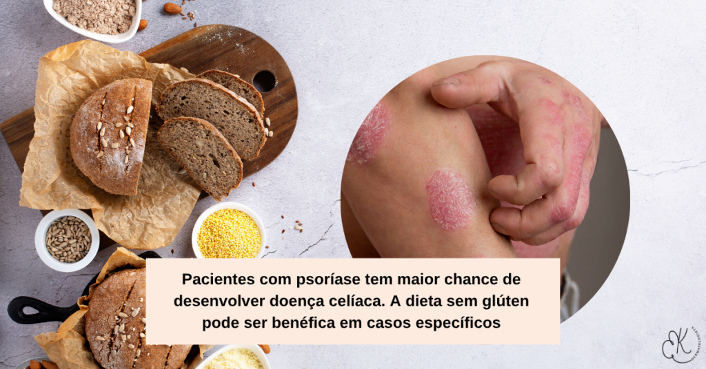 Braço com placas de psoríase ao lado de pães de trigo; texto indica maior chance de doença celíaca e benefício da dieta sem glúten em casos específicos.