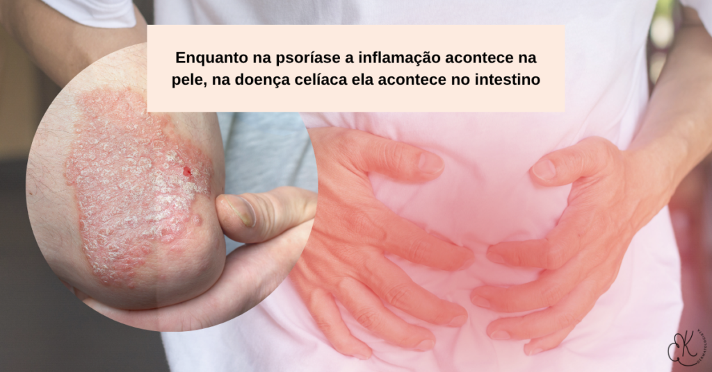 Imagem comparando inflamação na pele causada por psoríase e inflamação intestinal causada por doença celíaca