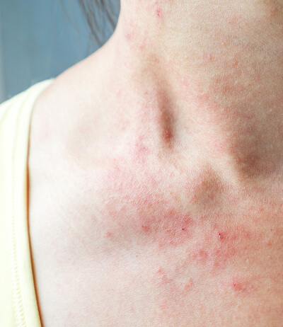ferramenta grau de psoriase