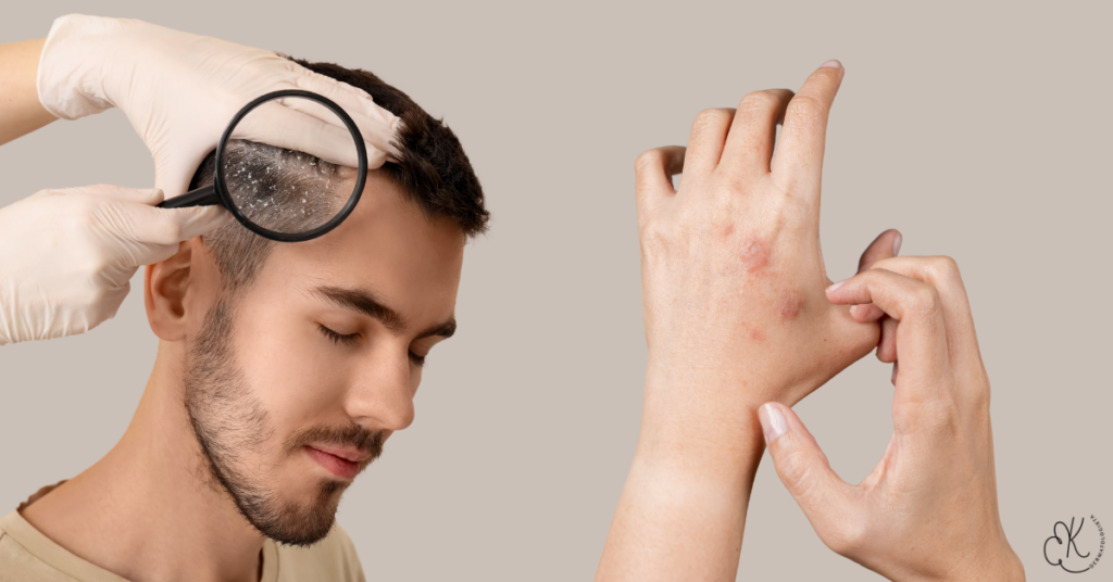 Paciente com psoríase no couro cabeludo e nas mãos durante avaliação em consulta dermatológica