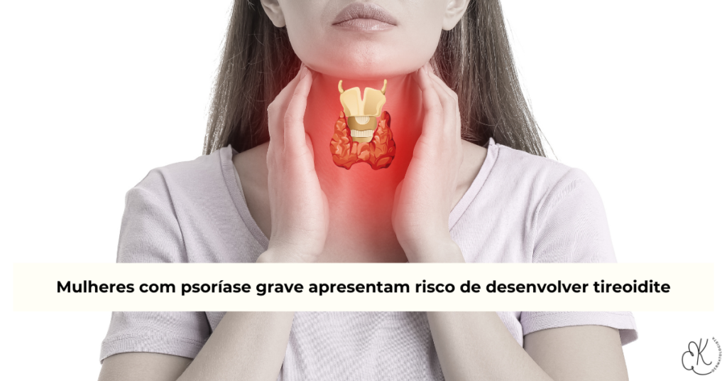 Pessoa segurando modelo da glândula tireoide, ilustrando risco de tireoidite autoimune em mulheres com psoríase grave.