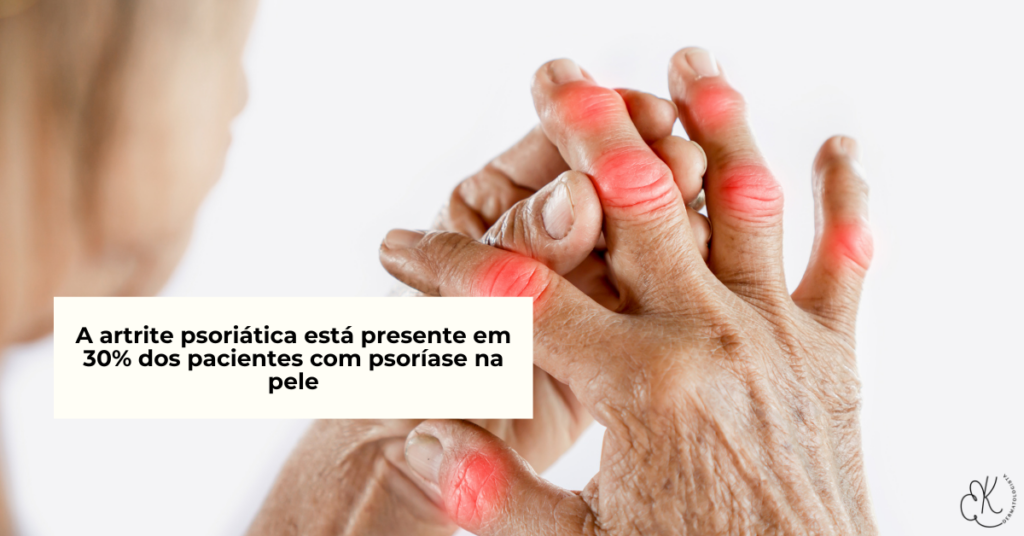 Mãos com articulações inflamadas e avermelhadas, ilustrando artrite psoriásica em paciente com psoríase.