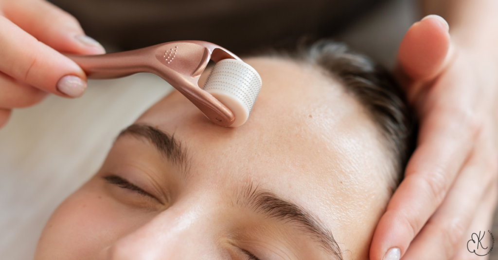 Procedimento de microagulhamento sendo realizado no rosto