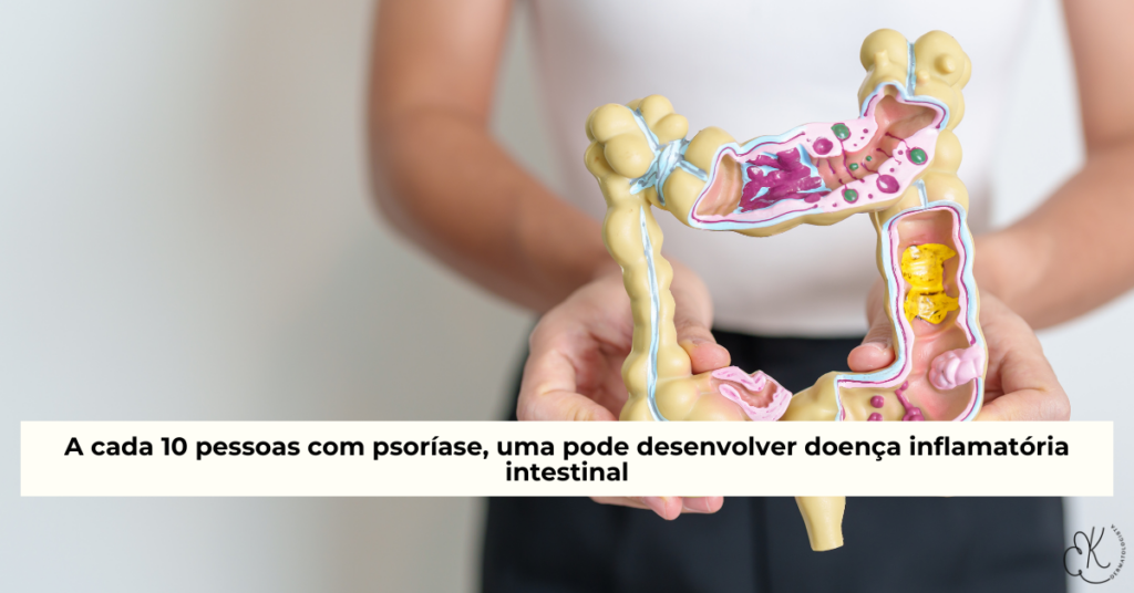 Modelo anatômico do intestino com áreas inflamadas, representando doença inflamatória intestinal associada à psoríase.