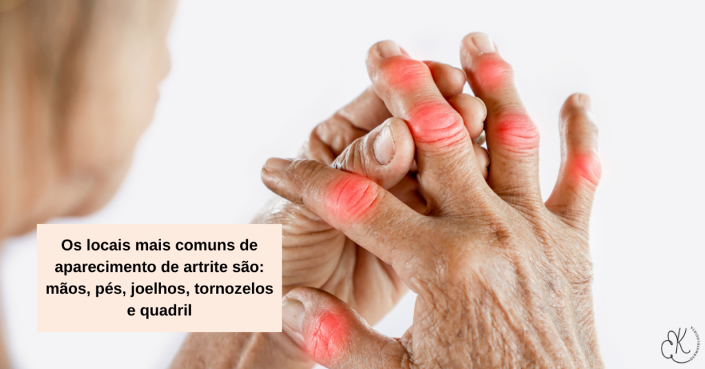 Pessoa com dor e inflamação nas articulações das mãos representando artrite pso