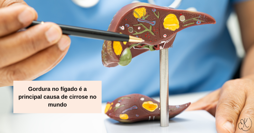 Modelo anatômico de fígado com áreas de gordura representando esteatose hepática