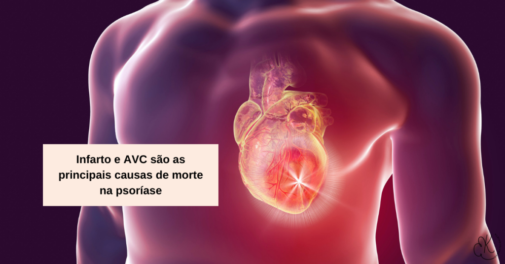 Ilustração do coração humano destacando risco cardiovascular aumentado em pacientes com psoríase