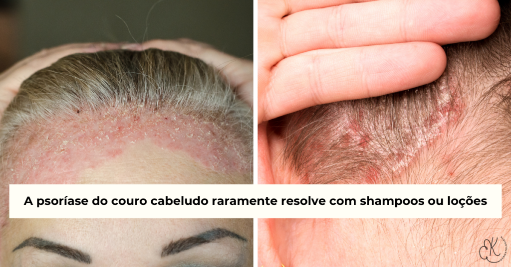 Psoríase no couro cabeludo com placas avermelhadas e descamação, mostrando que shampoos isolados raramente resolvem a inflamação.