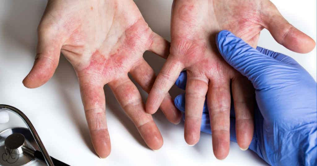 Psoríase nas palmas das mãos com placas avermelhadas e descamação, sendo avaliada por profissional de saúde.