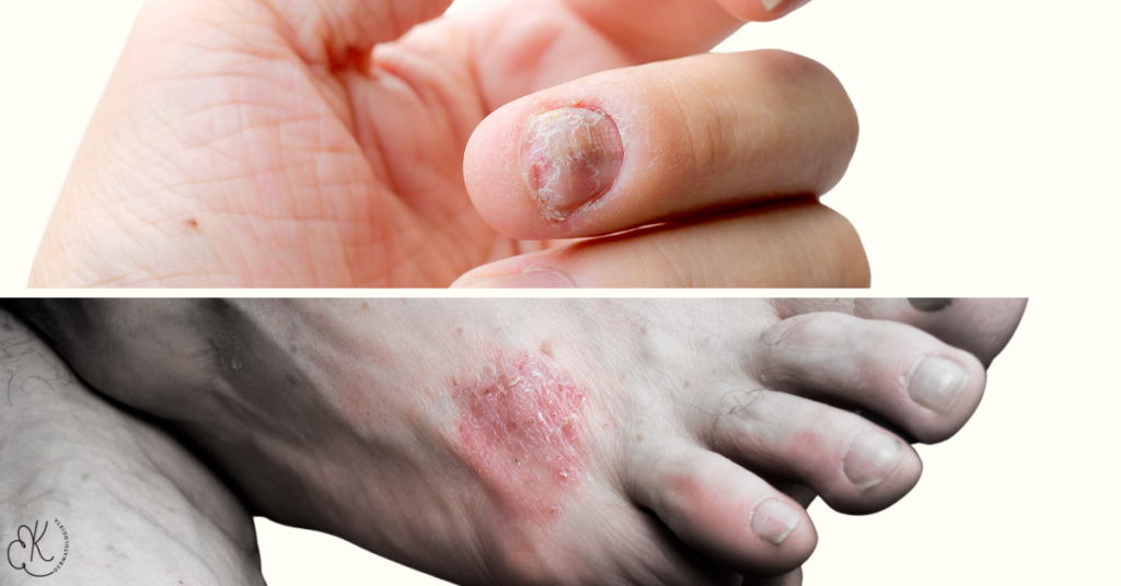 Psoríase na unha e lesão eritemato-descamativa no dorso do pé, áreas consideradas sensíveis e de difícil manejo.
