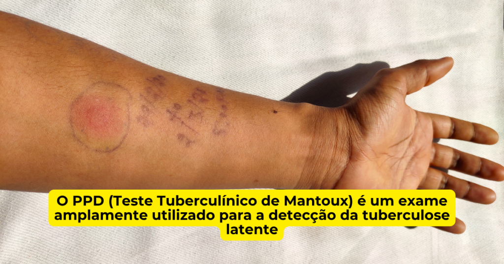 Braço com reação cutânea após teste PPD utilizado para detectar tuberculose latente