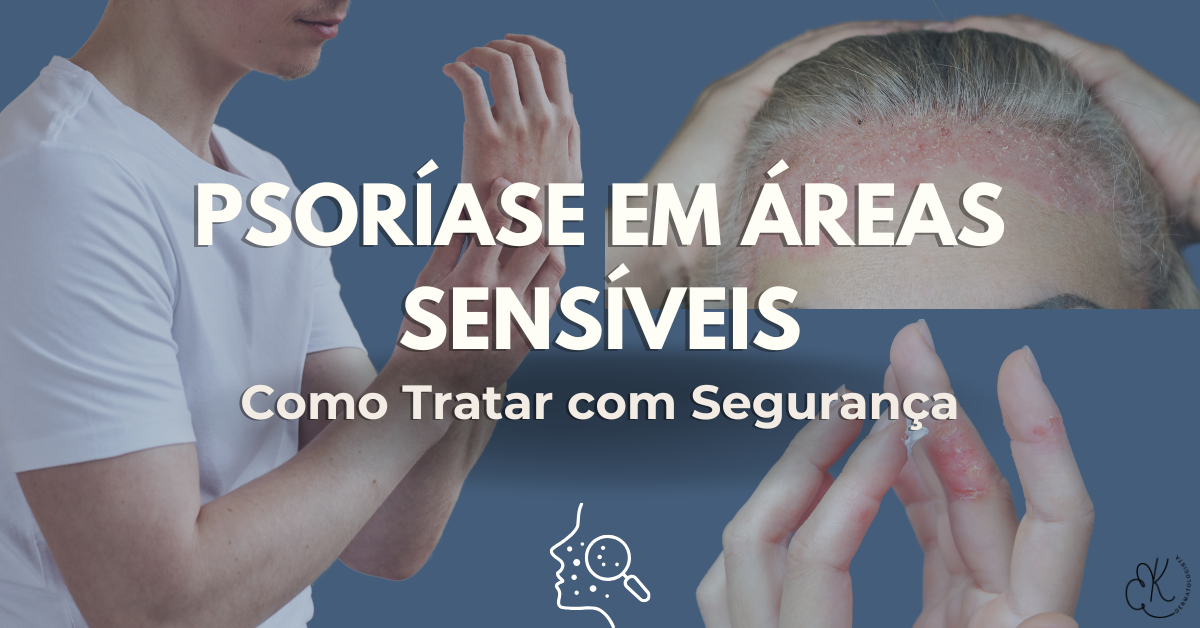 Ilustração representando psoríase em áreas sensíveis como couro cabeludo, mãos e dobras da pele.